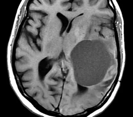 мозъчни киста на снимки, ядрено-магнитен резонанс на изображения, описанието на случая