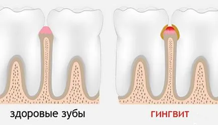 Кървене на венците по време на лечението на бременност