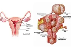 polipi în căile de atac populare uterului tratament