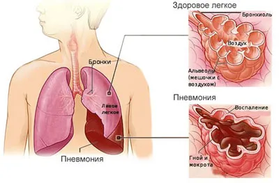 Левостранна пневмония, лечение на деца и възрастни