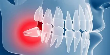 Bölcsesség kezelt fogak - jelzések kezelésére vagy eltávolítását őrlőfogak fogszuvasodás vagy fogbél