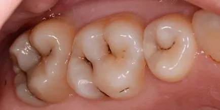 Bölcsesség kezelt fogak - jelzések kezelésére vagy eltávolítását őrlőfogak fogszuvasodás vagy fogbél