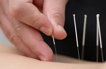 acupunctura tratament alcoolism