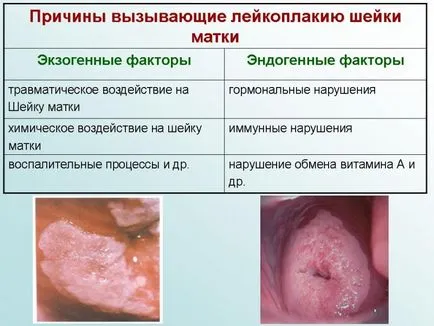 Лечение на левкоплакия на вулвата