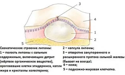 Lipoma a hátán és a gerinc okok, kezelés, következményeit, BNO-10 kód