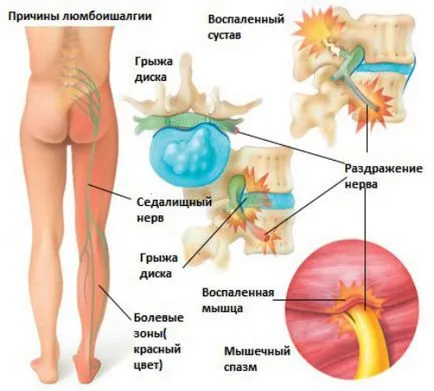 Лумбаго причина за болка, симптоми, лечение и лекарства у дома, упражнения