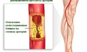 A pitvari fibrilláció, a szív, szív-érrendszeri betegség