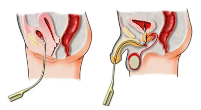 Изпразването на пикочния процедури за подготовка и провеждане на cystography