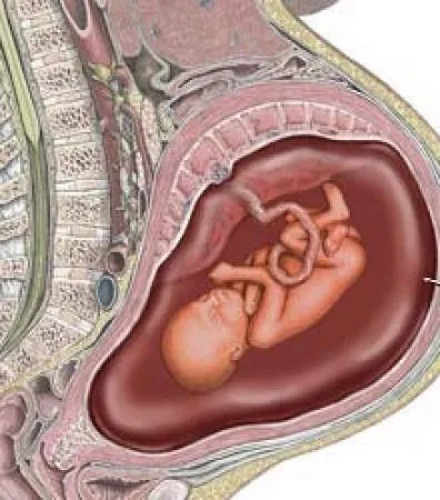 Polyhydramnios în timpul sarcinii