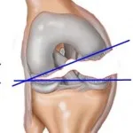 genunchi Lacrima ligamentelor tratament și simptome