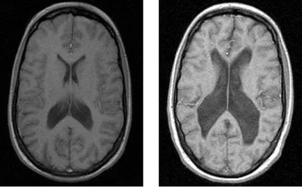 MRI szkizofréniában