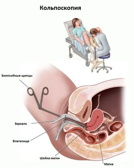 Възможно ли е да се направи колпоскопия по време на бременността на различни етапи, неговите характеристики и правила