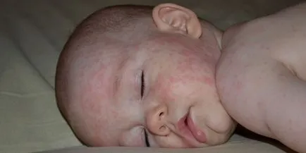 Rubeola - tünetek gyermekeknél - az első fertőzés jeleit, bőrkiütés fotó inkubáció