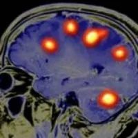 simptome tumorale laringe, de diagnostic și tratament - bisturiu - medical