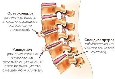 Osteocondrozei simptomelor lumbosacral si tratamente