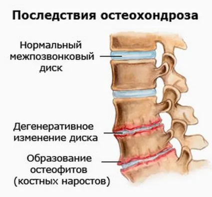 Osteocondrozei simptomelor lumbosacral si tratamente