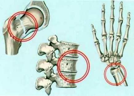 Simptomele osteoporozei si tratamentul de remedii populare