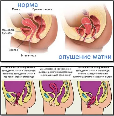 Пропускането на матката 1