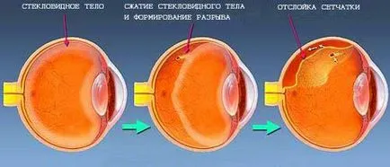 Dezlipirea de retină cauzele ce este, simptome, intervenții chirurgicale, tratamentul de remedii populare, comentarii