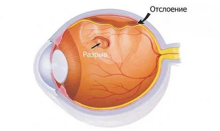 Dezlipirea de retină cauzele ce este, simptome, intervenții chirurgicale, tratamentul de remedii populare, comentarii