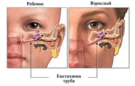 Отит на средното ухо при кърмачета предизвиква симптомите, лечението