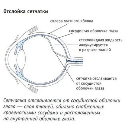 Dezlipirea de retină cauzele ce este, simptome, intervenții chirurgicale, tratamentul de remedii populare, comentarii