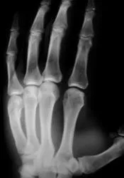 Fractura sau fisura, fisura sau fractura caz № 2, portal de radiologi