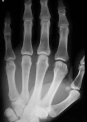 Fractura sau fisura, fisura sau fractura caz № 2, portal de radiologi