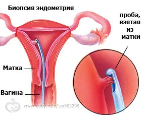 Paypel- биопсия на ендометриума