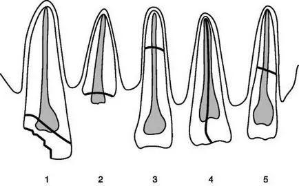 Törés a foggyökér tünetek és a kezelés, hosszirányú fogat törés