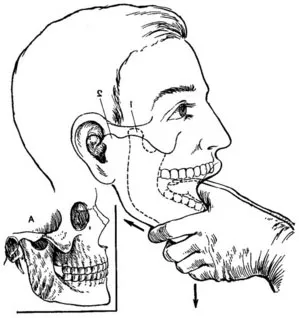 Subluxație de tratament maxilarului, simptome și de prim ajutor