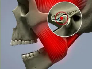 Subluxație al simptomelor maxilarului si tratament