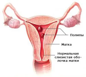 Рак на шийката на полипи