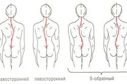 scolioză verso a coloanei vertebrale toracice