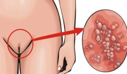 Cauze și manifestări ale HPV în vagin