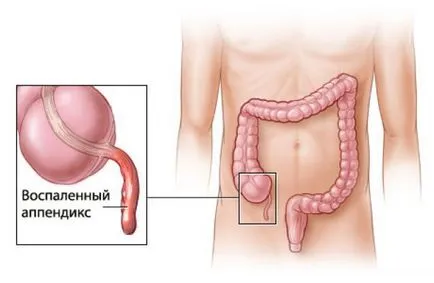 Jelek a vakbélgyulladás - hogyan, hogy ne váljanak áldozatává alattomos gyulladás