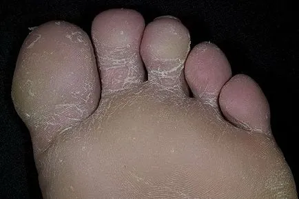 Semne de ciuperca pe unghii picioare