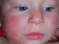 Rosacea arc fotó, okai, tünetei és kezelése rosacea, és más drogok