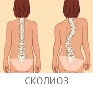 Маточната шийка-торакална остеохондроза - заболяване на гръбнака в гръдния диска, гърдата, фото и видео,