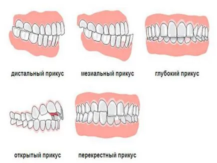 Merevítő összehangolása fogak hányan vannak, hogyan tegye