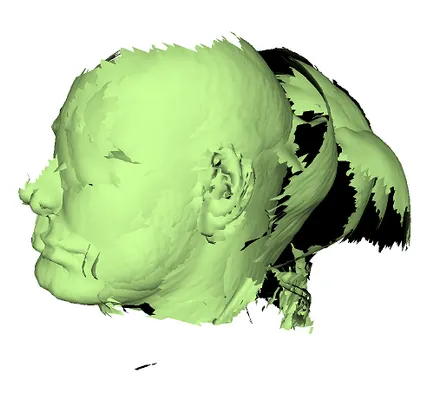 Scanarea capului copilului pentru a crea o casca ortopedic, artec3d știri