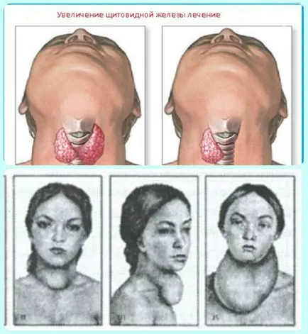 Симптомите на разширена функция на щитовидната жлеза, про shchitovidku