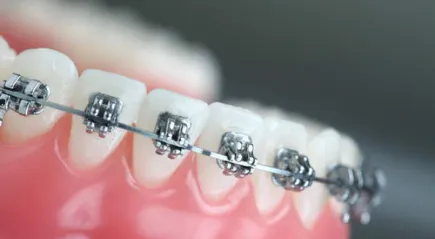 Презрамки за изравняване зъби от това колко са там, как да се сложи