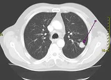 nodul pulmonar solitar