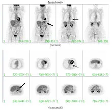 nodul pulmonar solitar