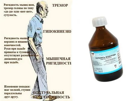 Водороден пероксид лечение на болестта на Паркинсон - прости и бързи рецепти за лечение на zdravoline