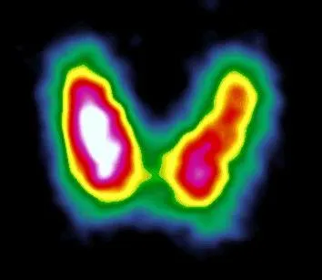 Сцинтиграфия на щитовидната жлеза и правилата на доказателства