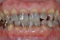 Тетрациклин зъби - лечение, избелване; Как да избелите зъбите тетрациклин, снимки