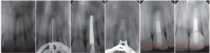Тетрациклин зъби - лечение, избелване; Как да избелите зъбите тетрациклин, снимки