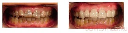 Тетрациклин зъби - лечение, избелване; Как да избелите зъбите тетрациклин, снимки